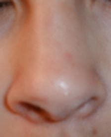 File:Human-nose.jpg - Wikipedia
