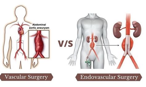 What is the Difference between Vascular and Endovascular Surgery?