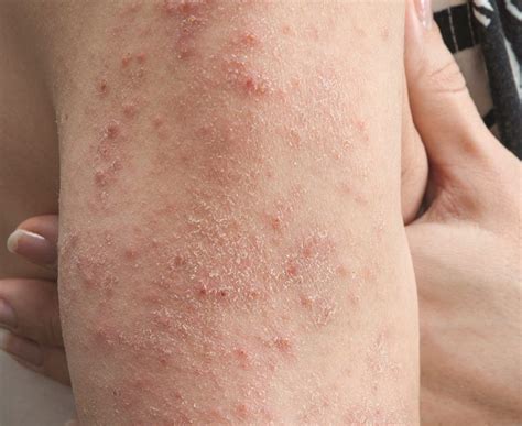 Celiac That's Skin Deep: The Mysterious Rash Sparked by Gluten Excema Treatment, Skin Acne ...