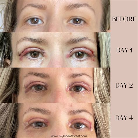 Upper Eyelid Lift | Before + After - My Kind of Sweet