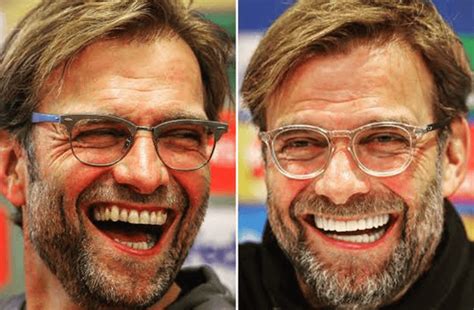 Jürgen Klopp Teeth - Dental Wise Turkey