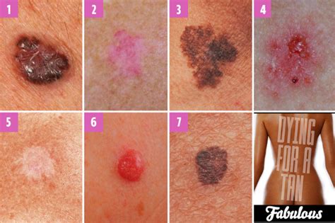 Can You Spot Which Moles Are Deadly? The Skin Cancer Signs You Need To CED