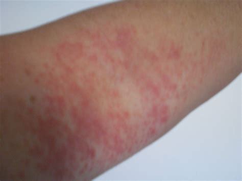 Small Red Rash On Arm