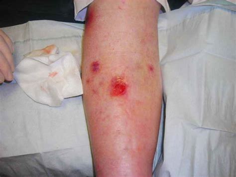 What Causes Sores On Legs And Arms - Printable Templates Protal