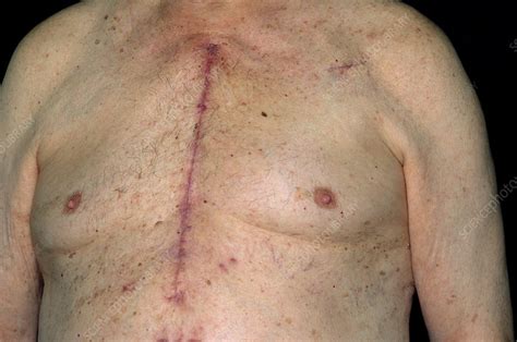 Heart surgery scar - Stock Image - M332/0091 - Science Photo Library