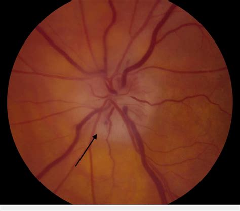 Right optic nerve showing chalky pallor with swollen disc (arrow) | Download Scientific Diagram