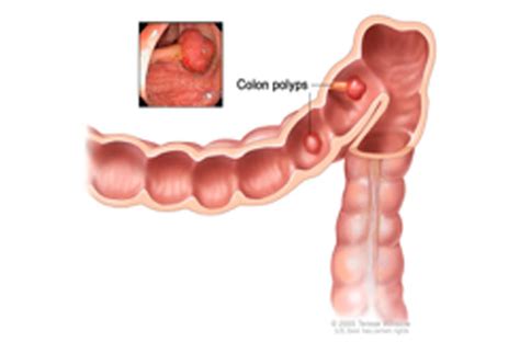 Small Intestine Cancer (Small Bowel Cancer)