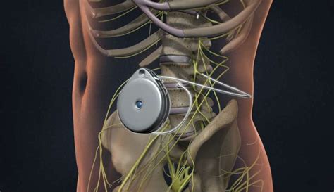 Understanding the Procedure of Intrathecal Drug Pump Implant - Charlton ...