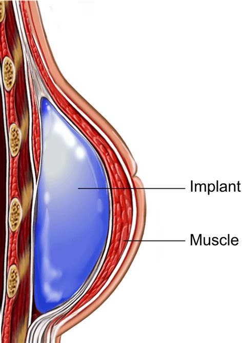 Breast Reconstruction Surgery with Tissue Expander - Cosmetic Surgery Tips