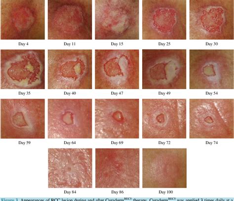 Skin Cancer Signs Treatment Types Of Skin Cancer Mela - vrogue.co