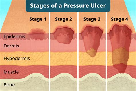 Pressure Ulcer: Bedsore Treatment for Stages 1 through 4