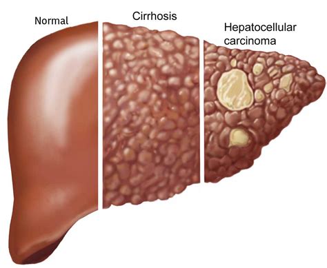 Liver Cancer Skin Lesions