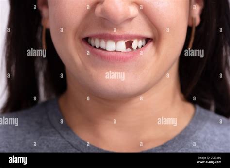 Smile close adult teeth missing hi-res stock photography and images - Alamy