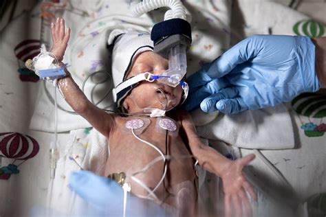 Level IV Preemie Care | TIME