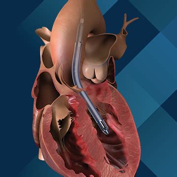 Explore the Minimally Invasive Impella 5.5® with SmartAssist® Heart ...