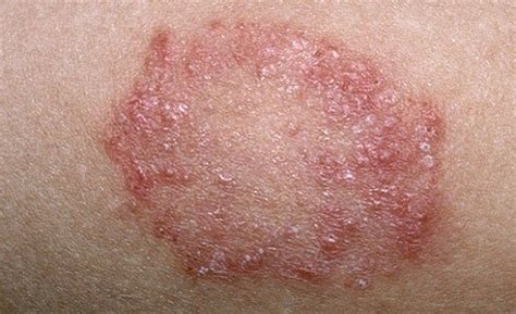 Skin Fungal Infection Pictures / Fungal Infection: Definition, Symptoms, Causes ... : Fungal ...