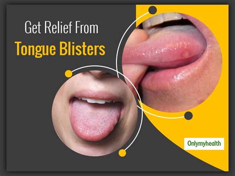 How To Get Rid Of Tongue Blisters - Staybite11