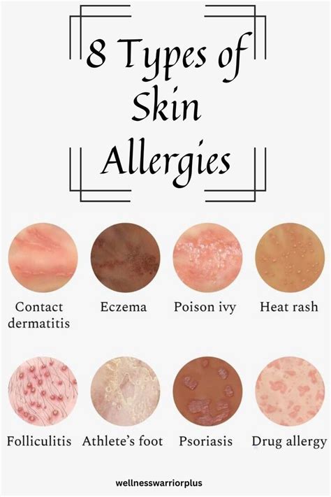 8 Types of Skin Allergies | Skin allergies, Allergies, Health tips