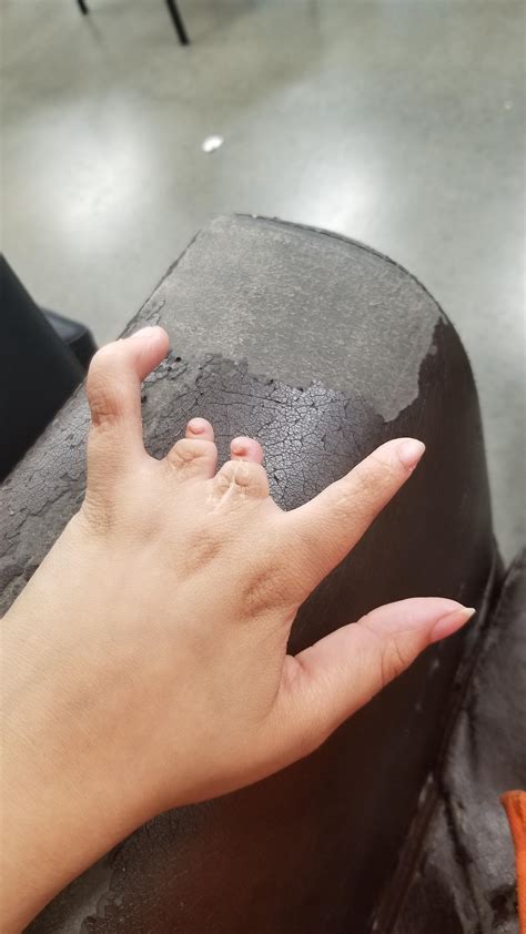 My left hand has a birth deformity : r/mildlyinteresting