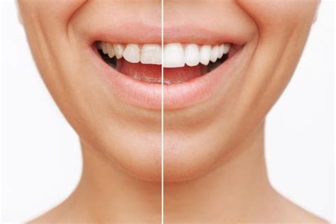 Veneers VS Lumineers: The Main Differences | Pros and Cons
