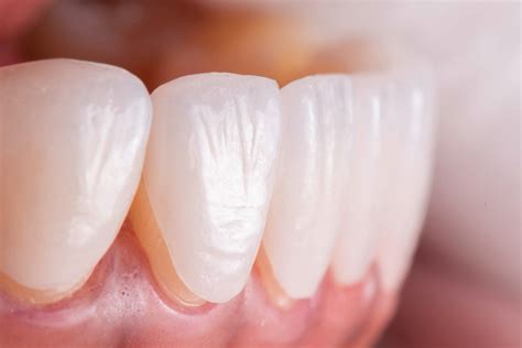 Dental Laminates Pros and Cons | Dental Laminates Bedford