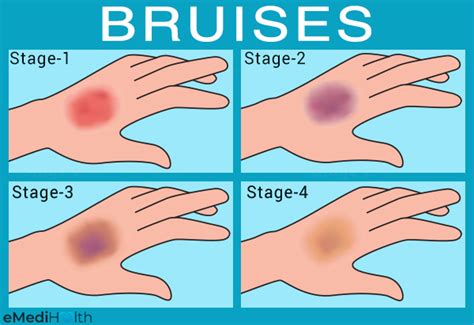 Possible Reasons and Risk Factors for Bruises - eMediHealth
