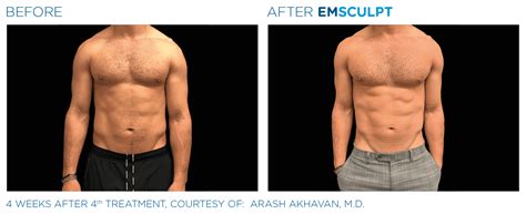 Emsculpt for men - The Cosmetic Skin Clinic