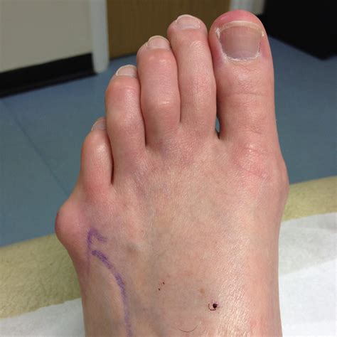 Bunion Surgery Leeds, | Yorkshire Foot HospitalYorkshire Foot Hospital