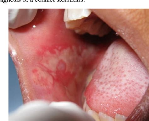 Figure 1 from Stomatitis Venenata- A Diagnostic Challenge | Semantic Scholar