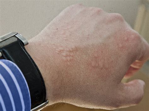 Rashes that look like scabies: Causes, symptoms, and treatment - Medical News Today