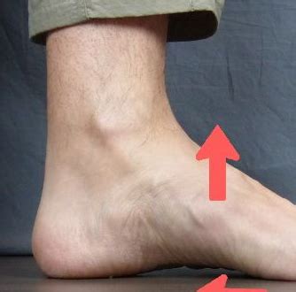 Hindfoot Valgus Symptoms, Causes, Exercises, Surgery