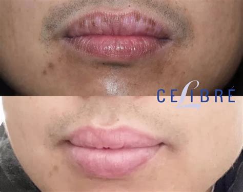 Lips Spots Removal : Dark And Sun Spots On Lips