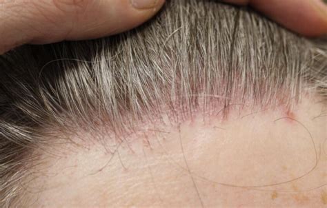 Frontal fibrosing alopecia