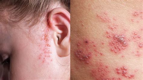 What-are-different-types-of-rashes