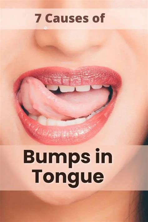 bumps under tongue Archives - MedicoGenius