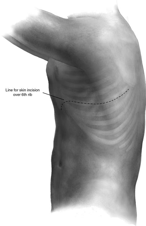 Technique of Pleurectomy and Decortication - Operative Techniques in Thoracic and Cardiovascular ...