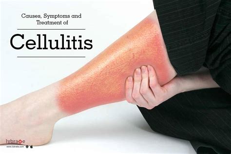 Cellulitis Causes Signs Symptoms Diagnosis Prevention - vrogue.co