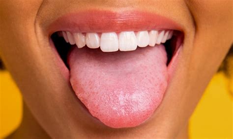 White Bump On Tongue Tip | Images and Photos finder