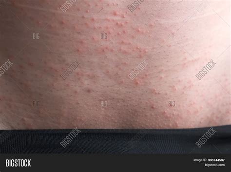 Rash On Skin Man Groin Image & Photo (Free Trial) | Bigstock