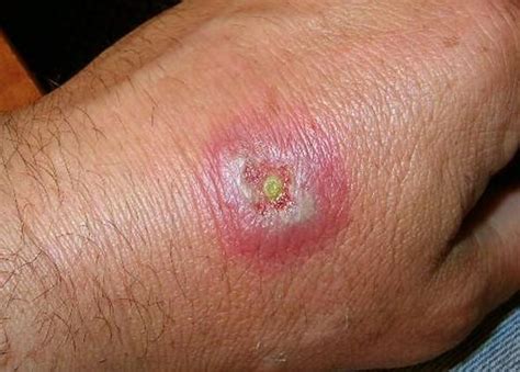 What Are The Symptoms Of A Brown Recluse Spider Bite Hobo Spider Bite | Images and Photos finder