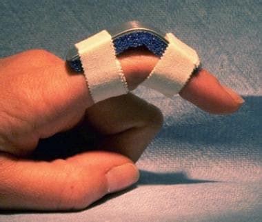 Volar Finger Splint