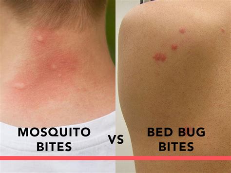 Mosquito Bites Vs Bed Bug Bites