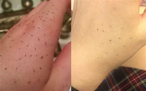 "Skin Gritting" Is Blackhead Removal Like You've Never Seen Before | Glamour