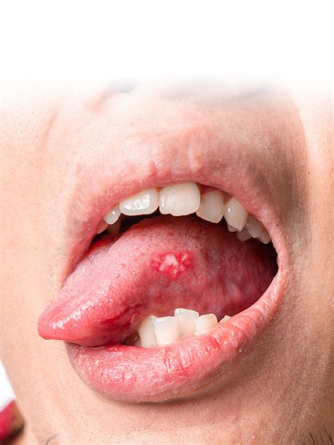 6 Ways to treat tongue blisters