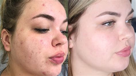 Before After Accutane Before After - vrogue.co