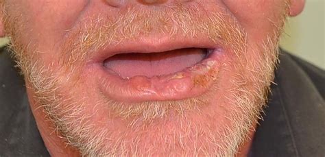 Basal Cell Carcinoma On Lip