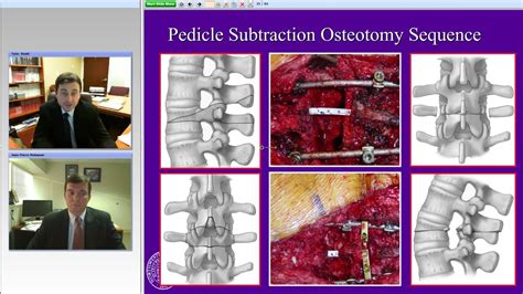 Spinal Deformity: Evaluation and Surgical Treatment - Part II (Preview) - YouTube