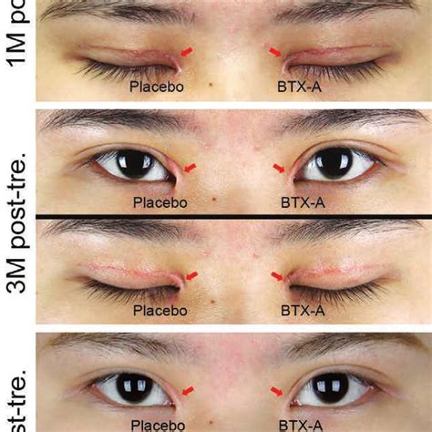 (Left , above and below) Before and after Park Z-epicanthoplasty.... | Download Scientific Diagram