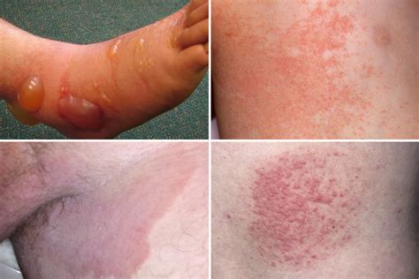 Plagued by a summer rash? How to tell if it’s heat rash or something more sinister | The ...