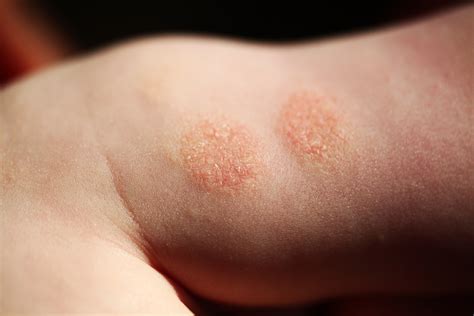 Eczema And Atopic Dermatitis Rashes Causes Symptoms